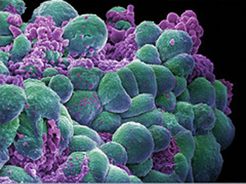 electron microscope image of breast cancer cells