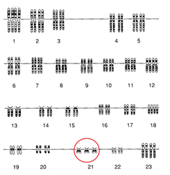 Image shows a Karyotype that has three chromosomes on the 21st pair.
