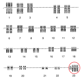 Image shows a Karyotype that has three chromosomes on the 23rd pair.