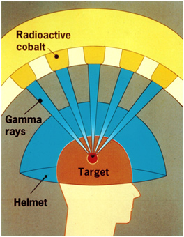 diagram of gamma knife surgery with gamma rays directed through a helmet at the target brain tumor