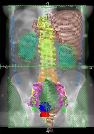 Image is an example of radiation therapy to the abdomen