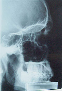 Image is of a x-ray