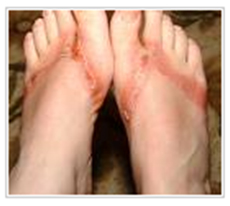 Photo of student's feet with second degree burns